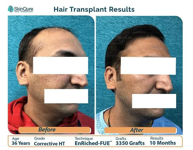 Everything You Must Know About Corrective Hair Transplant - SkinQure, Delhi
