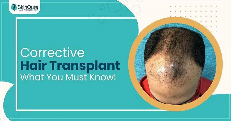 Everything You Must Know About Corrective Hair Transplant - SkinQure, Delhi