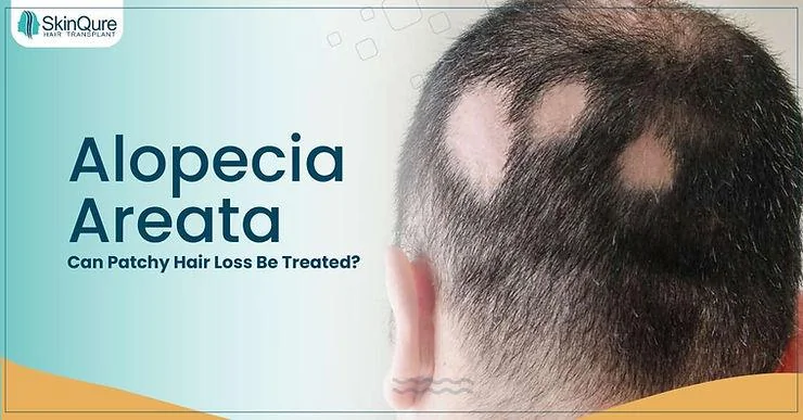 Alopecia Areata: Can Patchy Hair Loss Be Treated? - SkinQure, Delhi