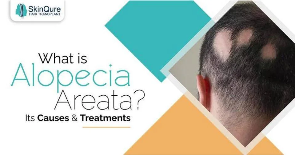 What is alopecia areata - its causes and treatments - SkinQure, Delhi