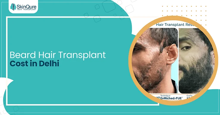 Beard Hair Transplant Cost in Delhi - SkinQure, Delhi