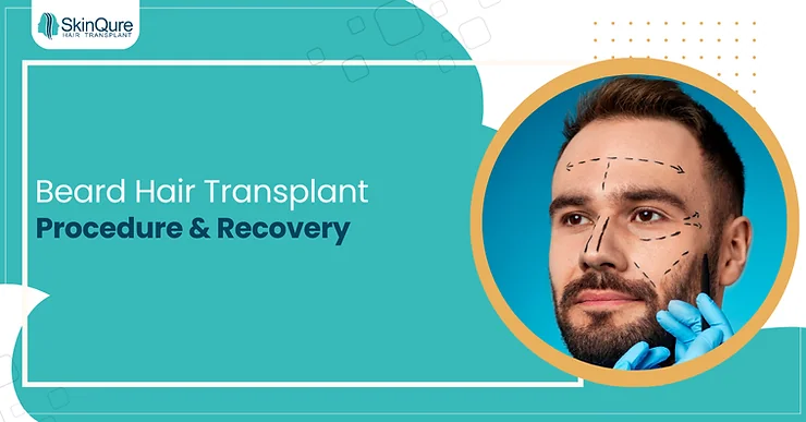 Beard Hair Transplant – Procedure & Recovery - SkinQure, Delhi