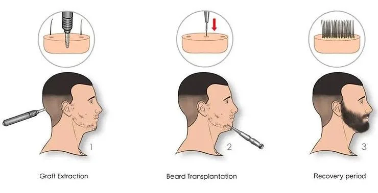 Beard Hair Transplant in Delhi Cost and Recovery - SkinQure, Delhi