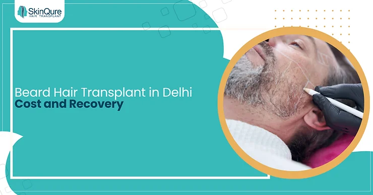 Beard Hair Transplant in Delhi Cost and Recovery - SkinQure, Delhi