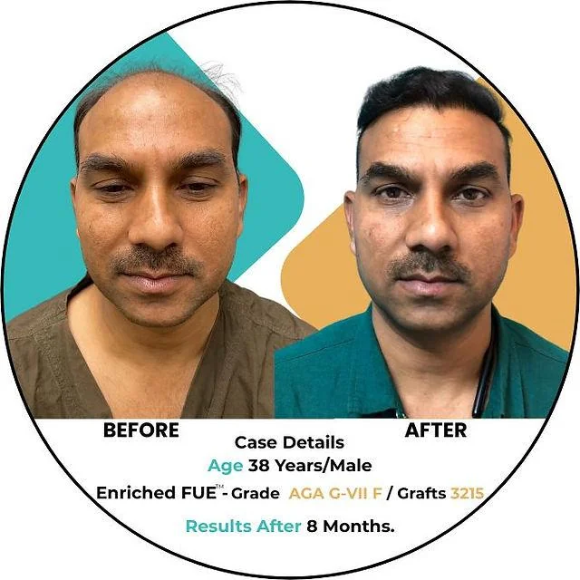 Hair Transplant in Delhi for a Natural Hairline Design - SkinQure, Delhi