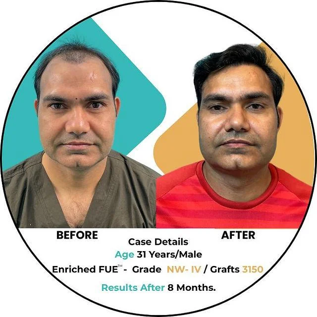 Hair Transplant Density: Achieving Maximum Coverage - SkinQure, Delhi