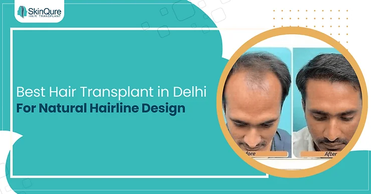 Hair Transplant in Delhi for a Natural Hairline Design - SkinQure, Delhi