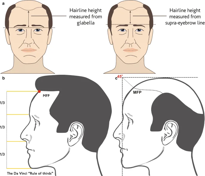 Experienced Hair Transplant Doctor in Delhi for Grade 3-5 Baldness - SkinQure, Delhi