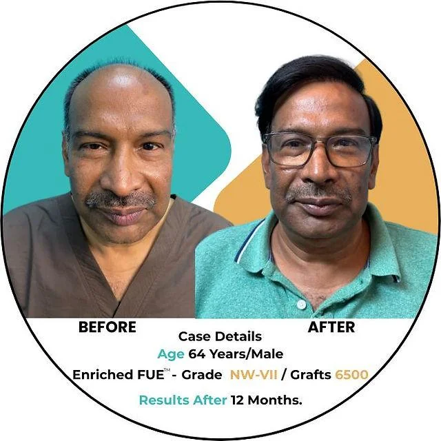 Hair Transplant Density: Achieving Maximum Coverage - SkinQure, Delhi