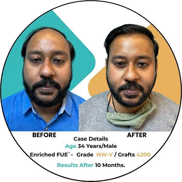 Hair Transplant Density: Achieving Maximum Coverage - SkinQure, Delhi