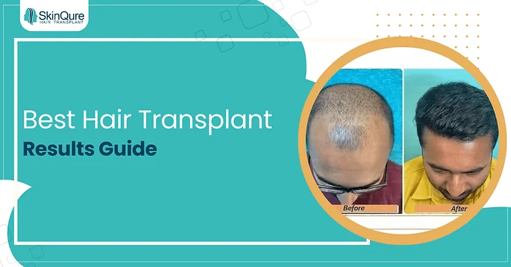 Hair Transplant Results Guide - SkinQure, Delhi