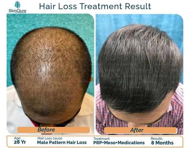 Biotin vs Finasteride for Hair Loss: Which is better? - SkinQure, Delhi
