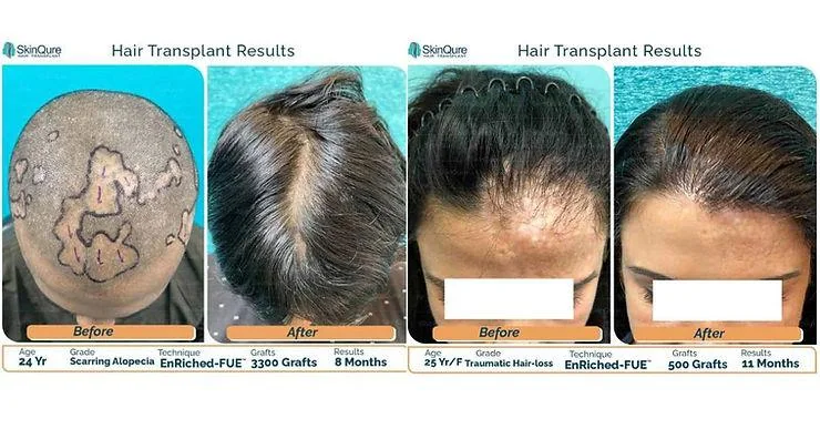 Can a Hair Transplant Be Done on a Scar? - SkinQure, Delhi