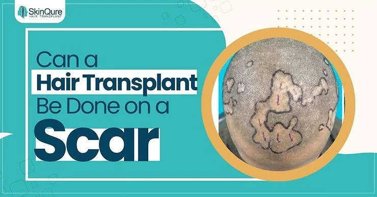Can a Hair Transplant Be Done on a Scar? - SkinQure, Delhi