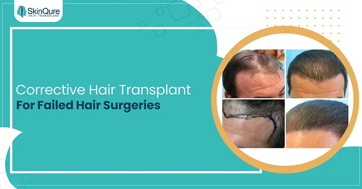 Corrective Hair Transplant For Failed Hair Surgeries - SkinQure, Delhi