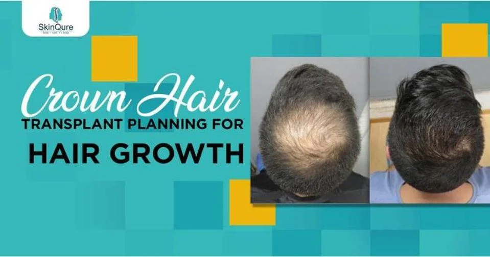 Crown hair transplant planning for hair growth - before and after - SkinQure, Delhi