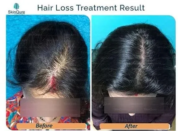 Exosome Therapy for Hair Loss: Cost, Safety, Efficacy, & Benefits - SkinQure, Delhi