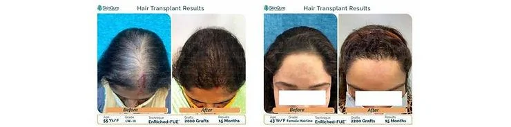 What is the Cost of a Female Hair Transplant in India? - SkinQure, Delhi