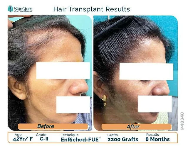 What Triggers Female Pattern Baldness? Treatment & Preventions - SkinQure, Delhi