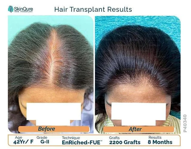 What Triggers Female Pattern Baldness? Treatment & Preventions - SkinQure, Delhi