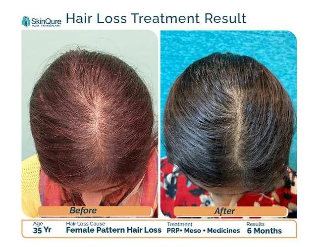 Female Hair Transplant in Delhi Causes and Options - SkinQure, Delhi