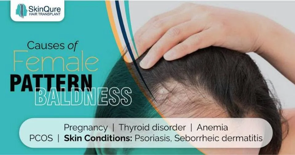 Causes of female pattern baldness - pregnancy, thyroid disorder, anemia, PCOS and skin conditions