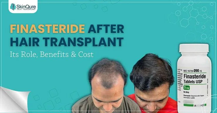 Finasteride After Hair Transplant: Its Role, Benefits & Cost - SkinQure, Delhi