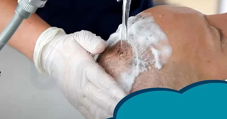 First Head Wash After Hair Transplant - Follow These Tips for Best Results - SkinQure, Delhi
