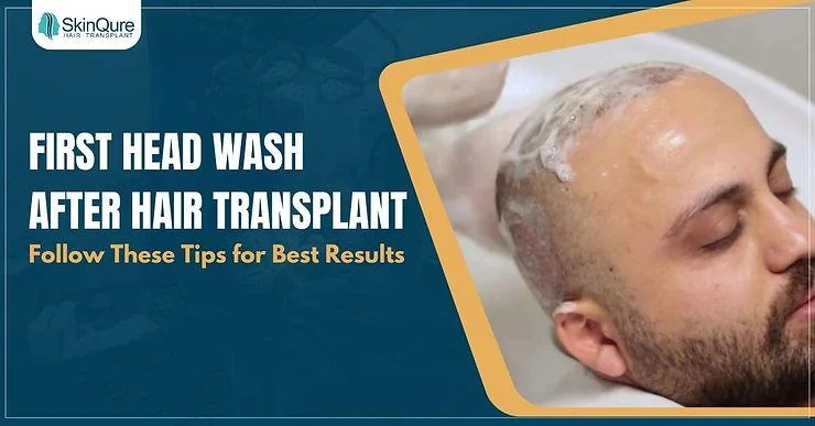 First Head Wash After Hair Transplant - Follow These Tips for Best Results - SkinQure, Delhi