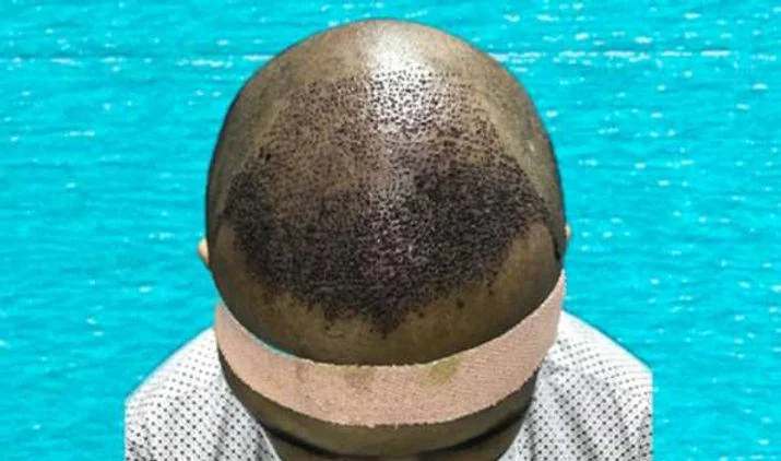 What to Expect During the First Month After a Hair Transplant? - SkinQure, Delhi