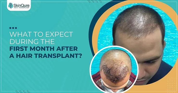 What to Expect During the First Month After a Hair Transplant? - SkinQure, Delhi