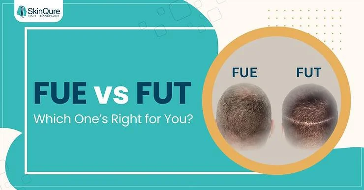 FUE vs FUT: What Type Of Hair Transplant Is Best For You? - SkinQure, Delhi