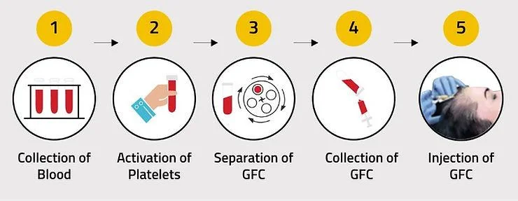 GFC Hair Treatment in Delhi: Benefits & Results - SkinQure, Delhi