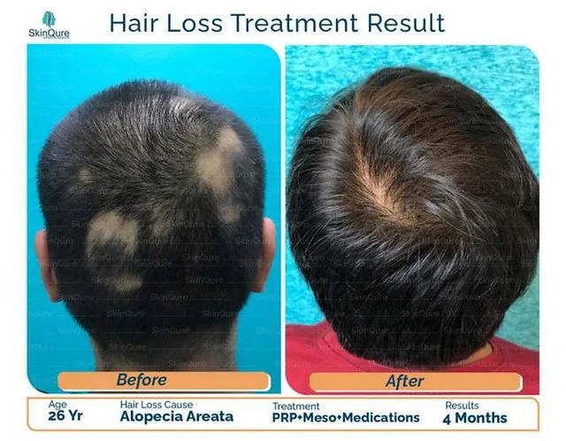 GFC Hair Treatment: What Is It & How It Works - SkinQure, Delhi