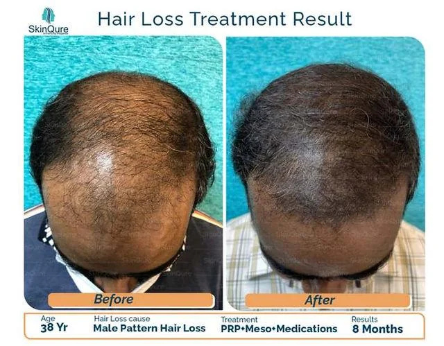 Biotin vs Finasteride for Hair Loss: Which is better? - SkinQure, Delhi