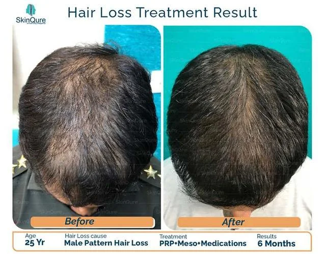 GFC Hair Treatment: What Is It & How It Works - SkinQure, Delhi