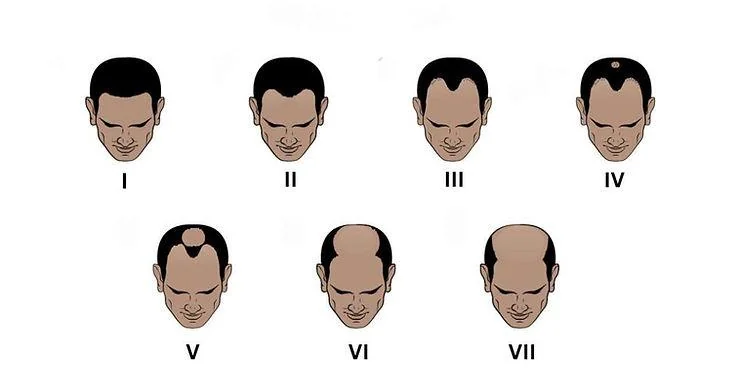 How to Handle Grade 4 Male Pattern Baldness: Expert Tips and Solutions - SkinQure, Delhi