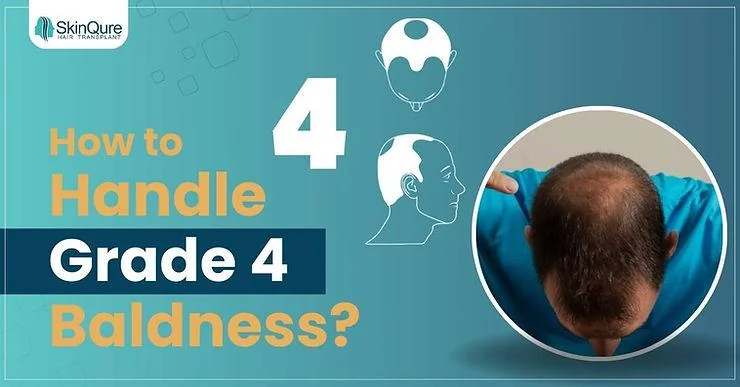 How to Handle Grade 4 Male Pattern Baldness: Expert Tips and Solutions - SkinQure, Delhi