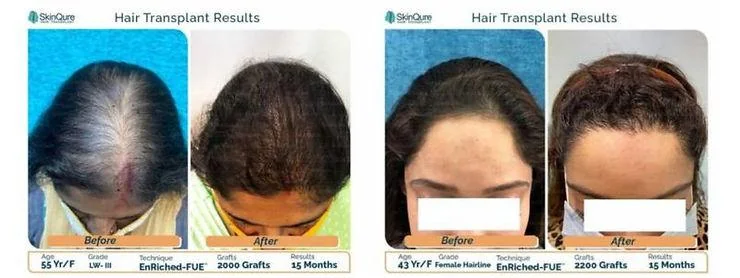 A complete guide to hair transplants for women: How to restore your hair - SkinQure, Delhi