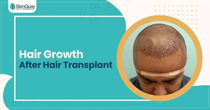 How long does it take for hair to grow after a hair transplant? - SkinQure, Delhi