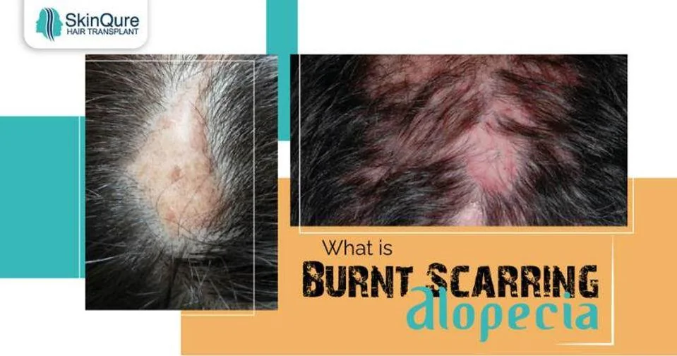 What is burnt scarring alopecia - hair loss from burns - SkinQure, Delhi