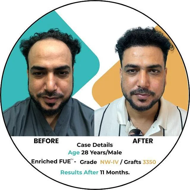 Hair Transplant Aftercare - How To Take Care of Hair After Hair Transplant? - SkinQure, Delhi