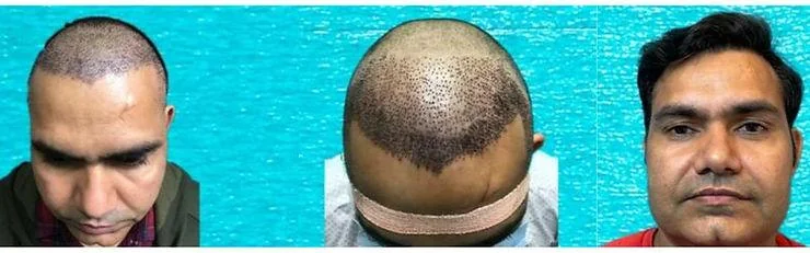 Best Hair Transplant Aftercare Tips for Outstanding Results - SkinQure, Delhi