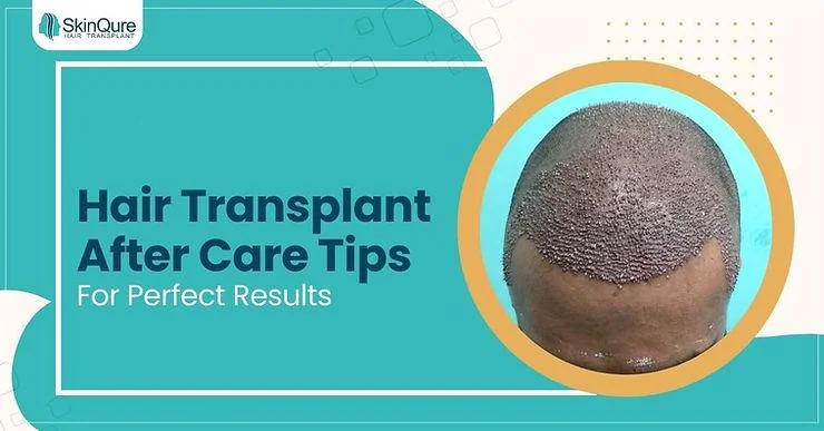 Best Hair Transplant Aftercare Tips for Outstanding Results - SkinQure, Delhi