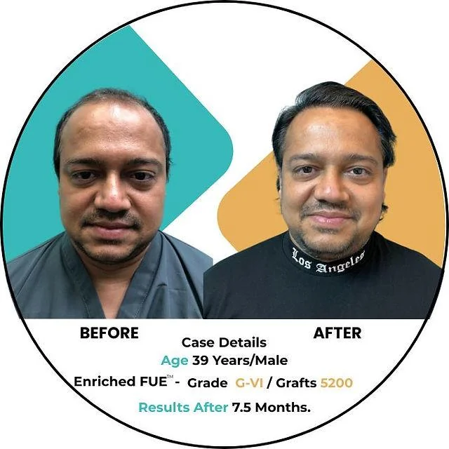 Hair Transplant Age Limit: When Is Too Young or Too Old? - SkinQure, Delhi