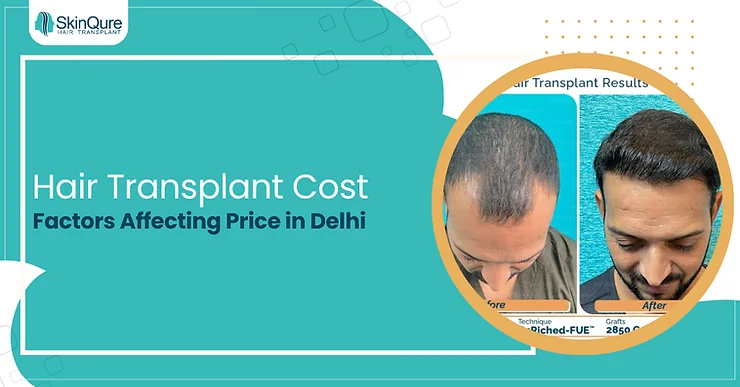 Hair Transplant Cost: Factors Affecting Price in Delhi - SkinQure, Delhi