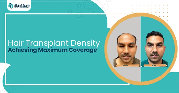 Hair Transplant Density: Achieving Maximum Coverage - SkinQure, Delhi