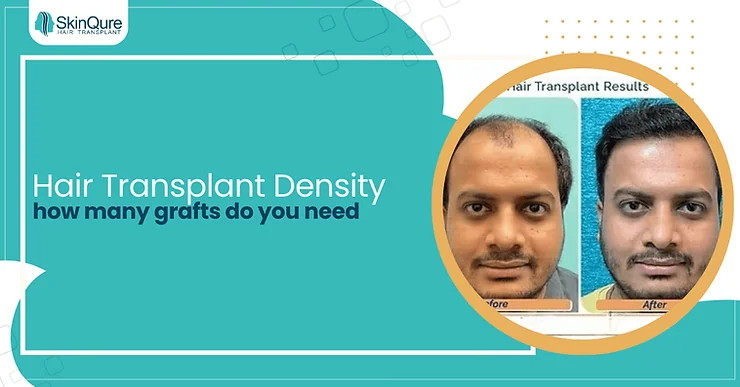 Hair Transplant Density: How Many Grafts Do You Need - SkinQure, Delhi