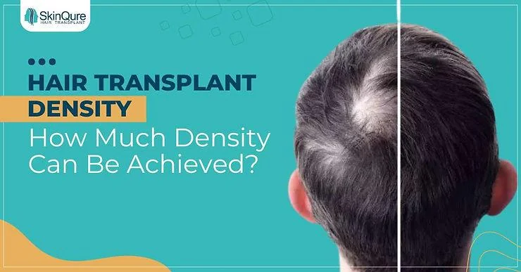 Hair Transplant Density: How Much Density Can Be Achieved? - SkinQure, Delhi