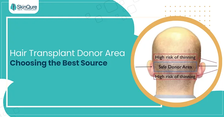Hair Transplant Donor Area: Choosing the Best Source - SkinQure, Delhi